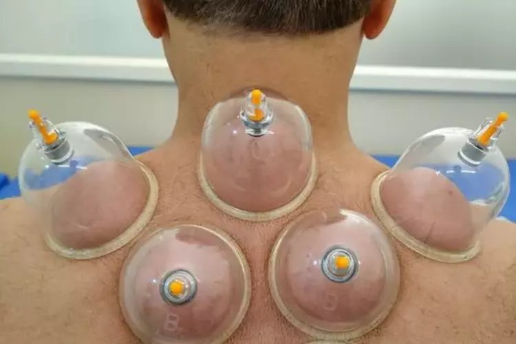 Cupping Therapy - Healing Hands Advanced Physiotherapy Clinic