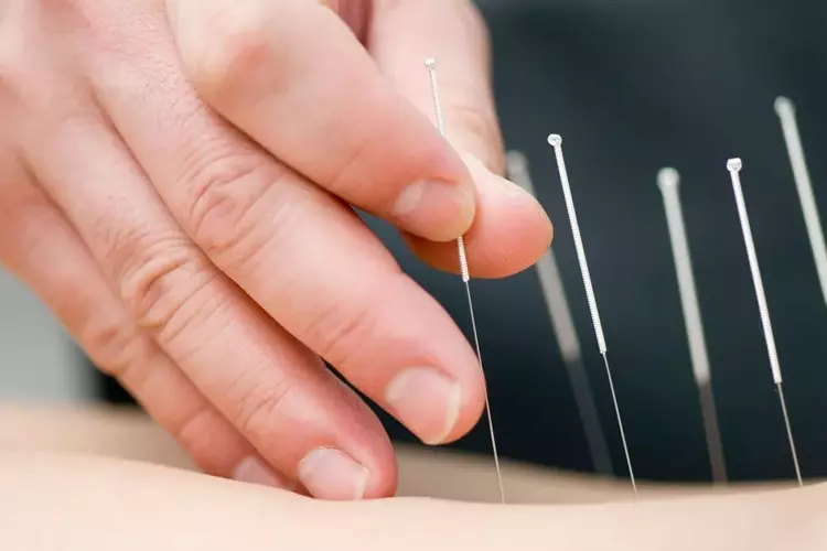 Dry Needling Therapy - Healing Hands Advanced Physiotherapy Clinic